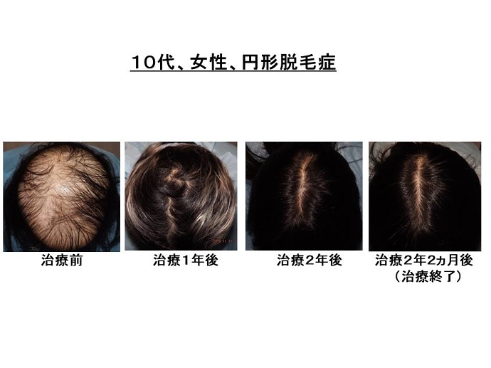 円形脱毛症　病院""
